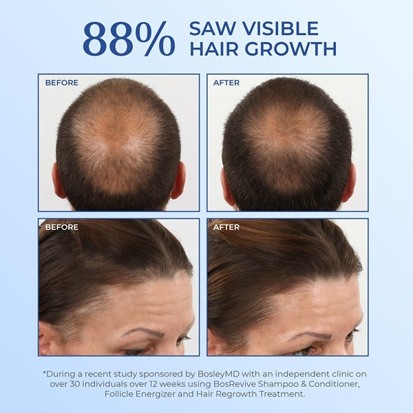 Bosleymd Hair Loss Shampoo Non Colour Treated 1 Litre