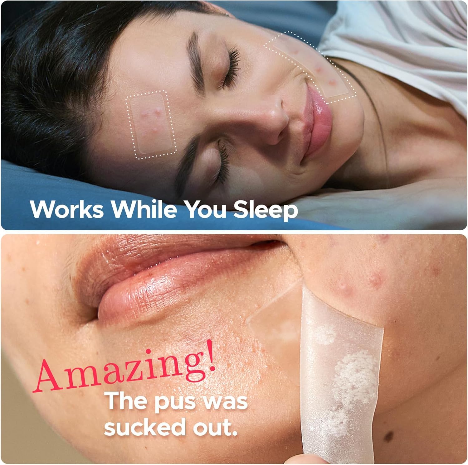 Litbear Large Pimple Patches, 5 Sizes 324 Patches Big Acne Patches, Xl Hydrocolloid Bandages For Full Face, Forehead, Chin, Nose, Body, Back, Neck & Chest, Stirp, Square Large Hydrocolloid Patch : Beauty & Personal Care