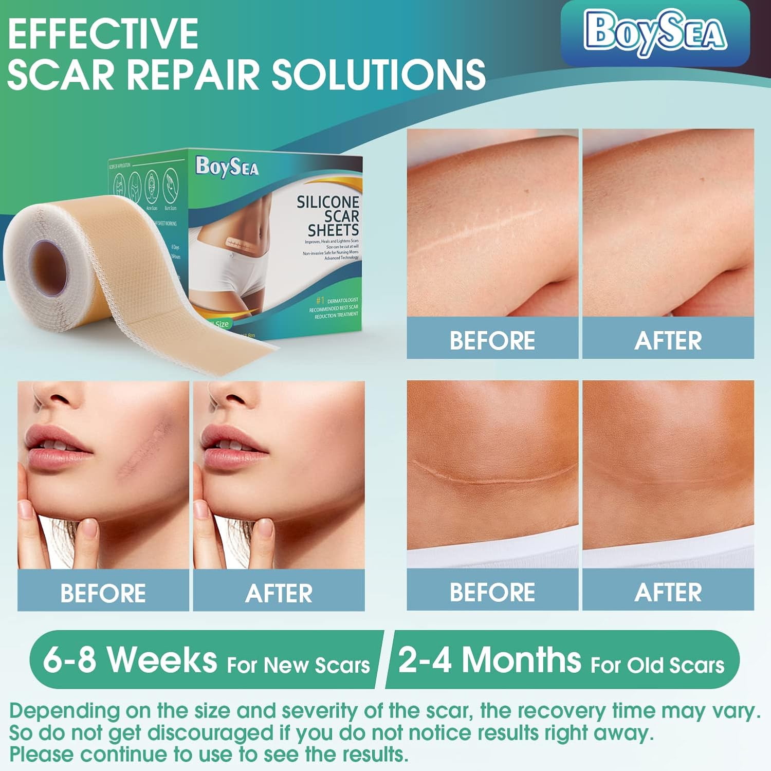 Professional Silicone Scar Sheets (1.6" X 150" Scar Roll-3.8M) - Scars Removal Treatment - Reusable Silicone Scar Tape Strips Type For Keloid, C-Section, Surgery, Burn, Acne Et : Health & Household