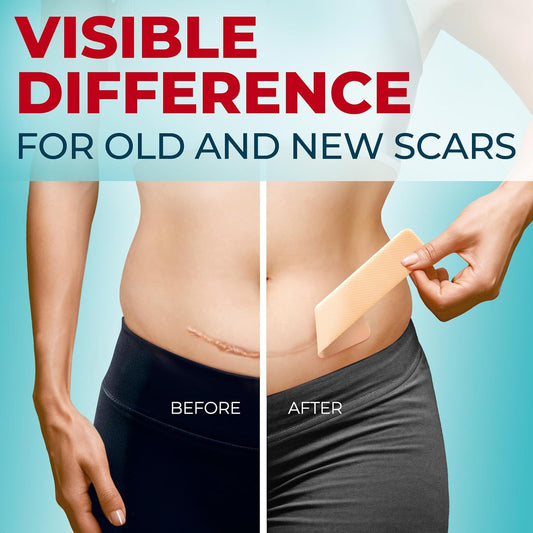 Medical Grade Silicone Scar Tape - 1.6”X150” - Visible Difference On Keloid & ?-Section - Reusable Silicone Scar Sheets - Easy To Use