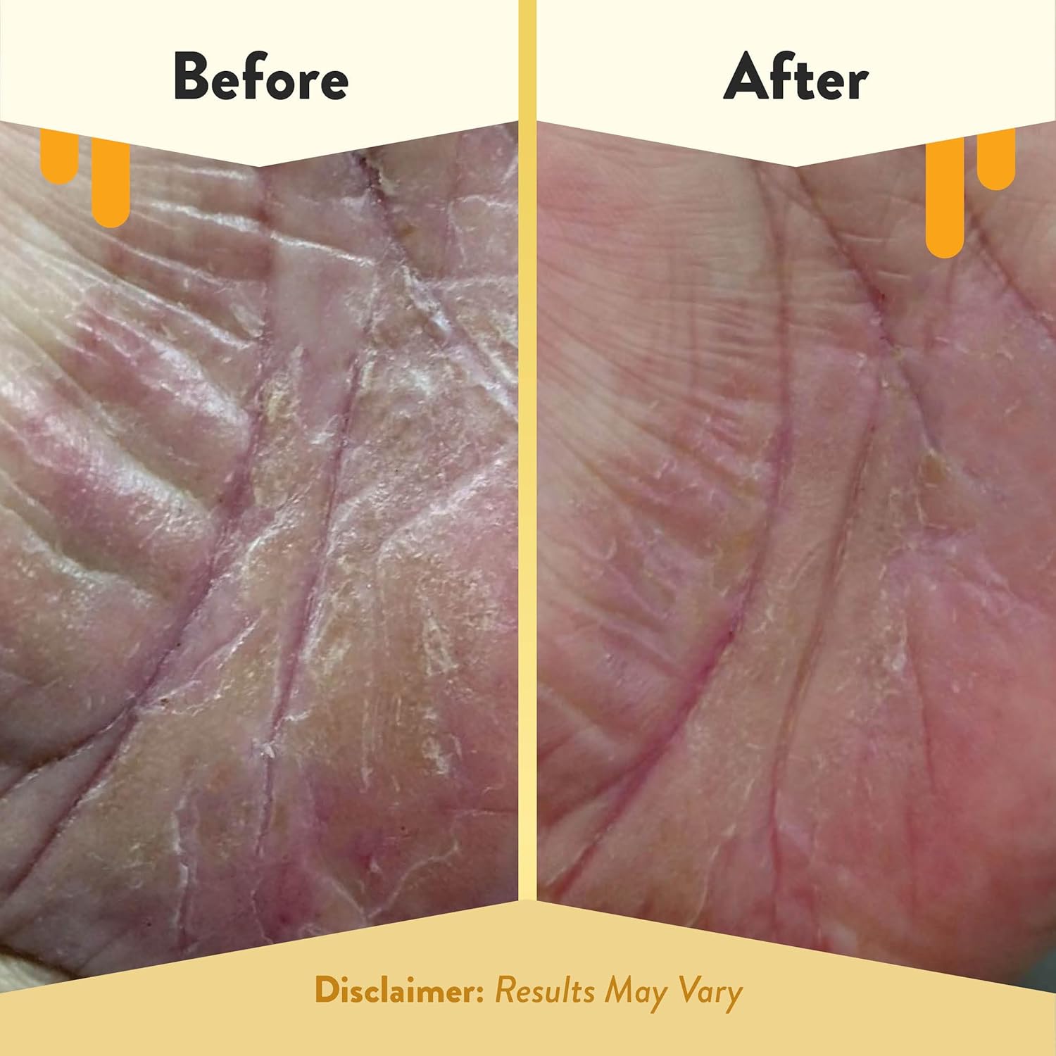 Eczema Honey Brown Sugar Face & Body Scrub - Bath Scrub For Dry Skin - Natural & Gentle Face Scrub Soothes Eczema - Body Care Products For Women & Men - Sensitive Skin Exfoliating Body Scrub (6 Oz) : Beauty & Personal Care