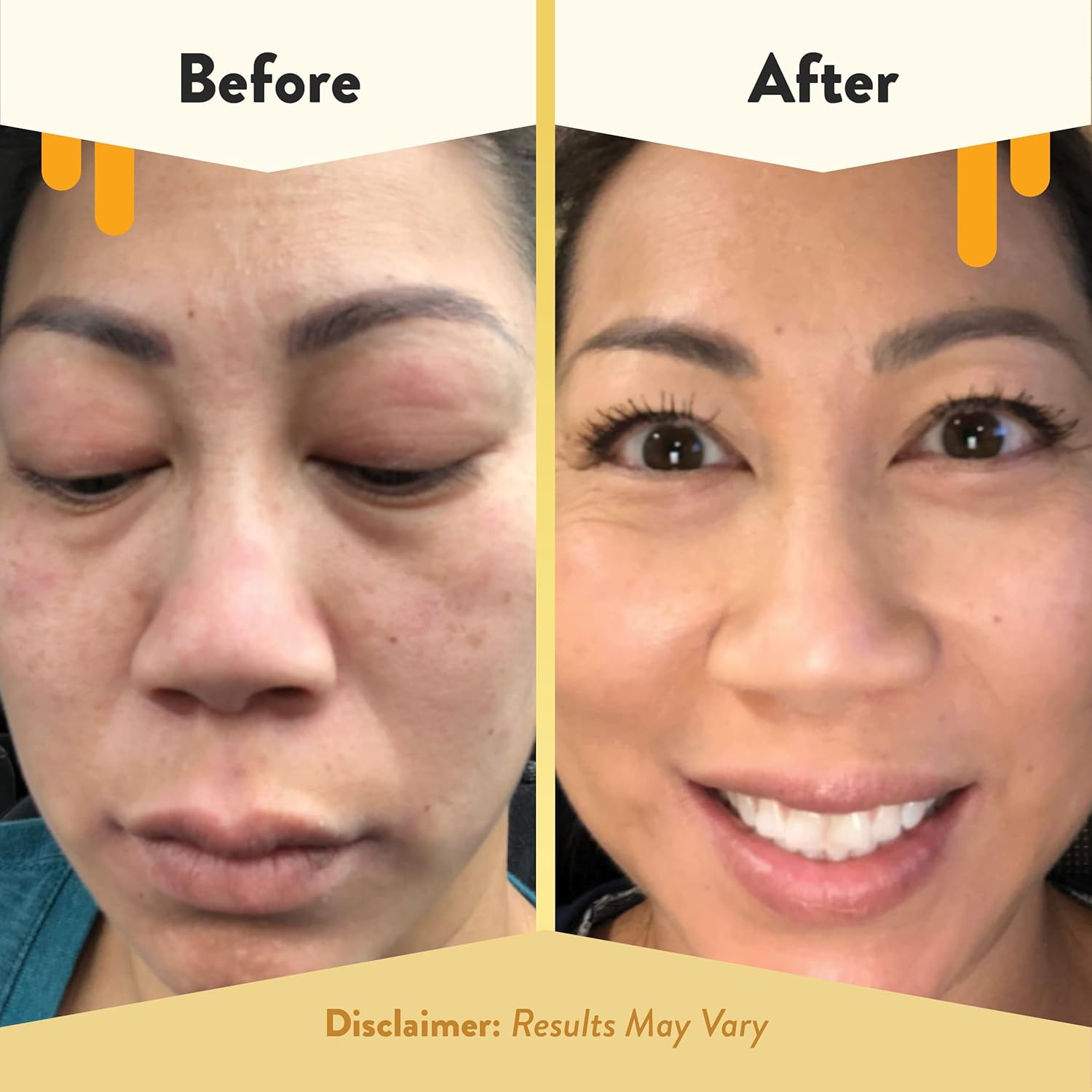 Eczema Honey Soothing Facial Cream - Eczema Lotion For Face, Eyelids, Lips, And More - Natural Dry Skin Repair (2 Oz) : Beauty & Personal Care