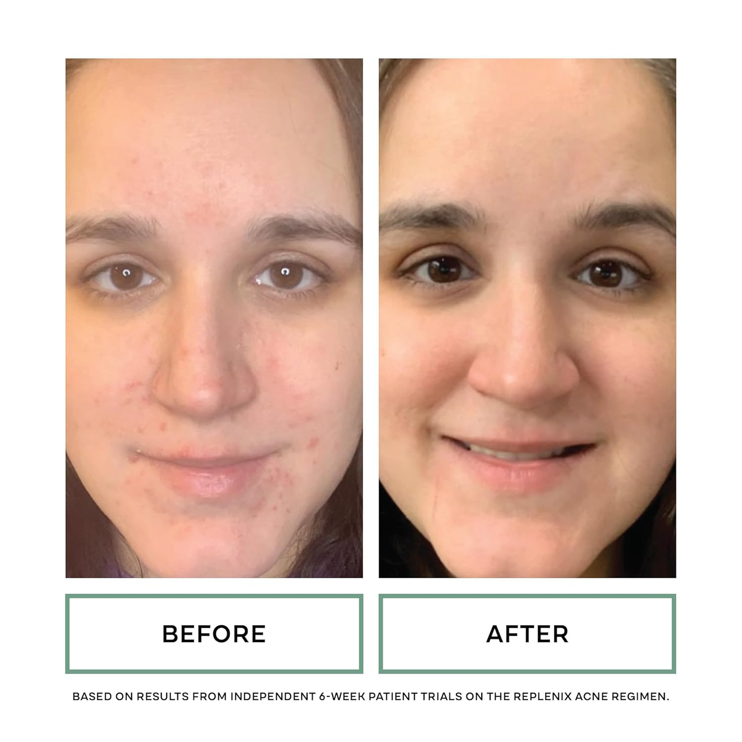 Replenix Benzoyl Peroxide Acne Gel 10% Spot Treatment : Beauty & Personal Care