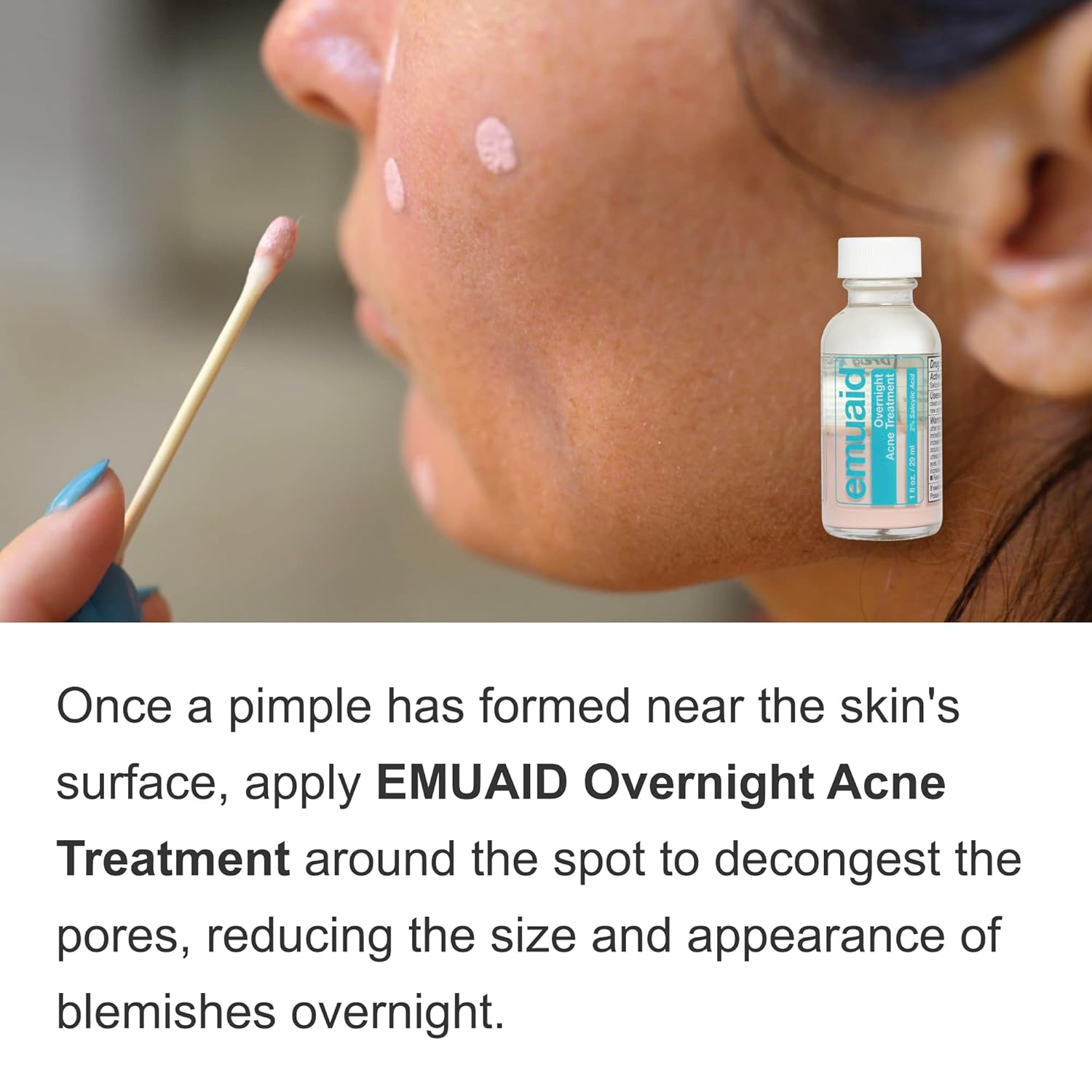 Emuaid Overnight Acne Solution Bundle - Emuaid Overnight Acne Treatment With Therapeutic Moisture Bar : Beauty & Personal Care