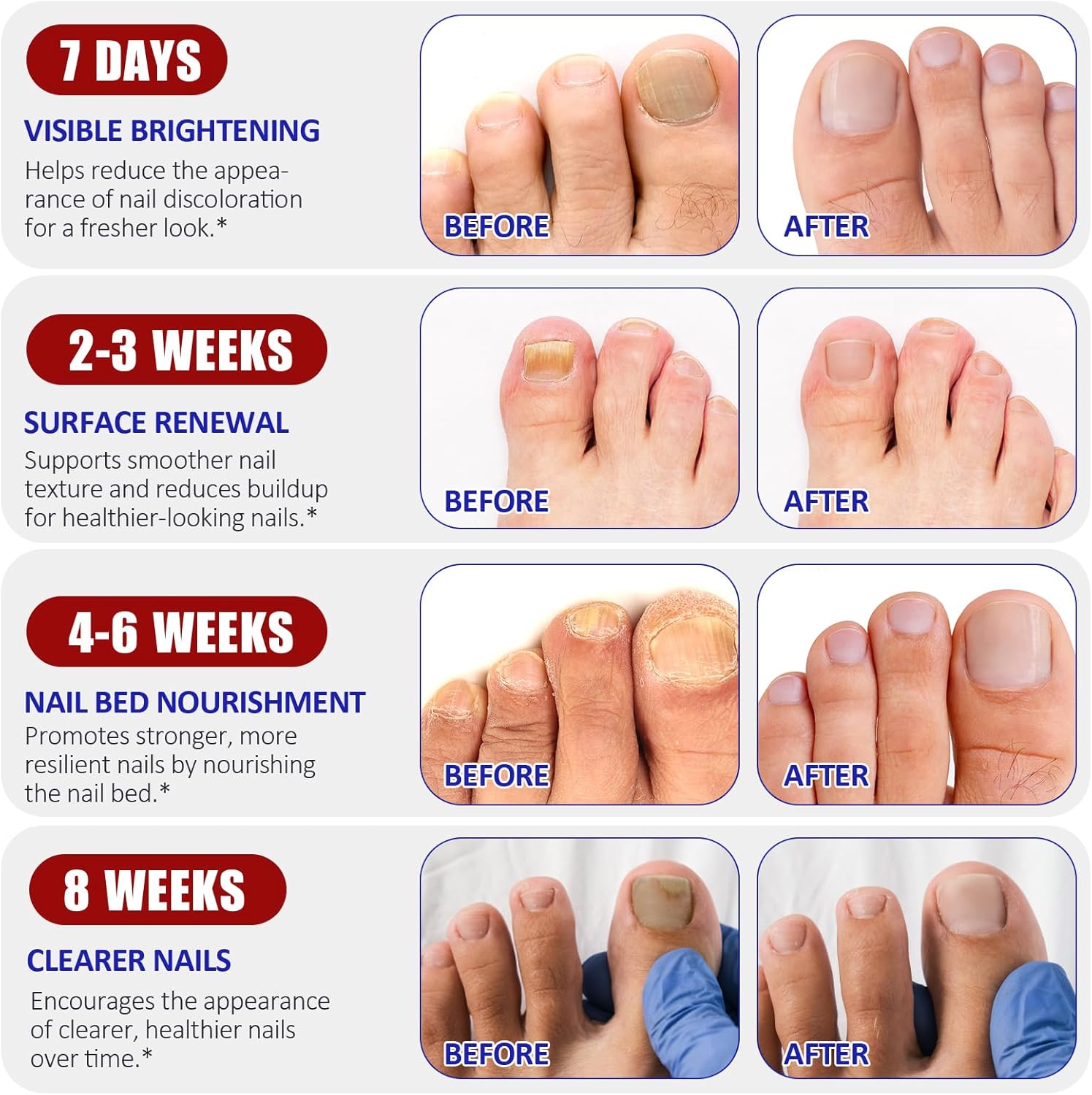 Fungal Nail Patches For Toenails, 32Pcs Fungal Nail Treatment Patches, Nail Repair For Damaged Nails - Improves Nail Appearance, Revitalizes Brittle Nails, Reduces Discoloration & Thickness