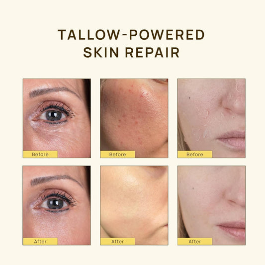 Grass Fed Beef Tallow For Skin: Organic Whipped Tallow And Honey Balm - Nourishing Body & Face Moisturizer - Deep Hydration, Eczema Psoriasis & Dermatitis, 2.3 Oz