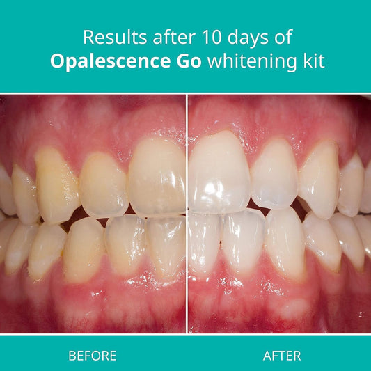 Opalescence Go 15- Prefilled Teeth Whitening Trays - 15% Hydrogen Peroxide - (10 Treatments) Made by Ultradent Products. Mint - 5194-1