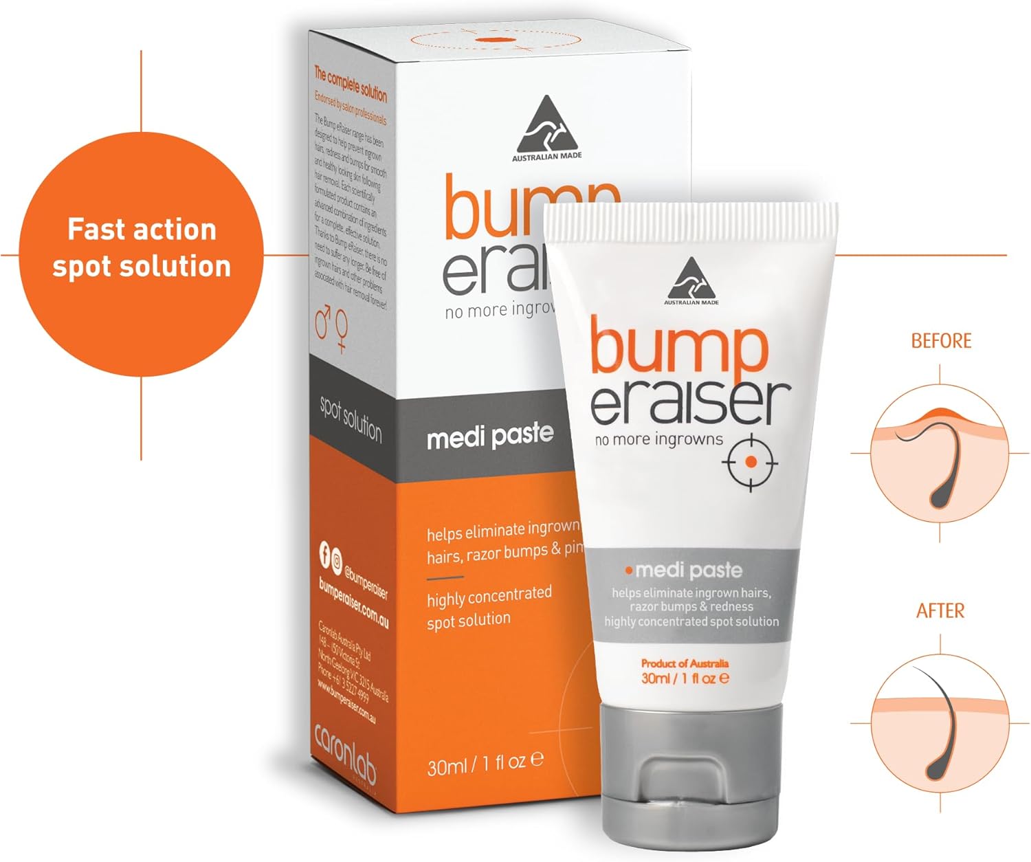 Bump Eraiser Medi Paste 30ml The Spot Treatment for Ingrown Hairs, Pimples, Razor Bumps and Razor Burns : Amazon.co.uk: Health & Personal Care