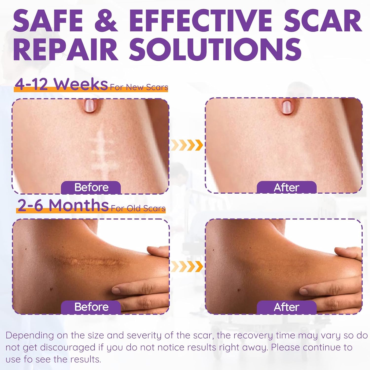 Silicone Scar Sheets, Silicone Scar Tape(1.6"X 79" Roll-2M), Reusable Professional Scar Silicone Strips, Soft Silicone Scar Sheets For Surgical Scars,Keloid,Acne Scars,Burn Scar,C-Section : Health & Household