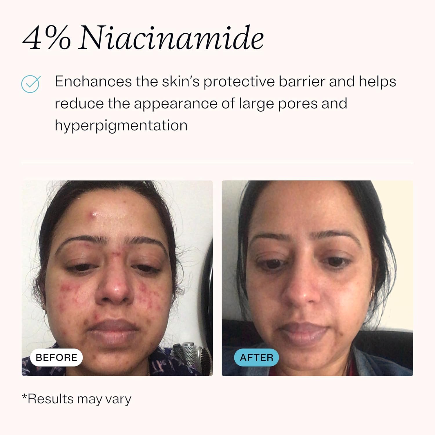 Mdacne – Retinol 0.5% And Niacinamide 4% Cream, Reduces Blemishes And Improves Skin Texture Without Irritation : Beauty & Personal Care