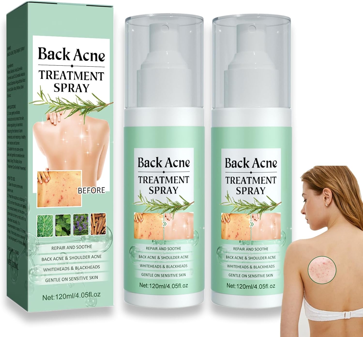 Back Acne Treat-Ment Spray, Lighten Acne Marks Skin Care Spray, Herbaluxy Back Acne Treat-Ment, Body Moisturiser For Dry Skin, Repair Back Shoulder Acne & Body Acne & Chest Acne & Butt Acne (2Pcs)