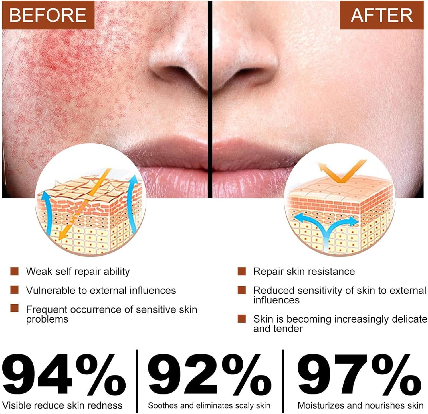 Redness Relief For Face, Rosacea Repair Secrums, Redness Reducing Treat, Moisturizing Facial Serums To Repair Skin Barrier, 1 Fl Oz Bexdug