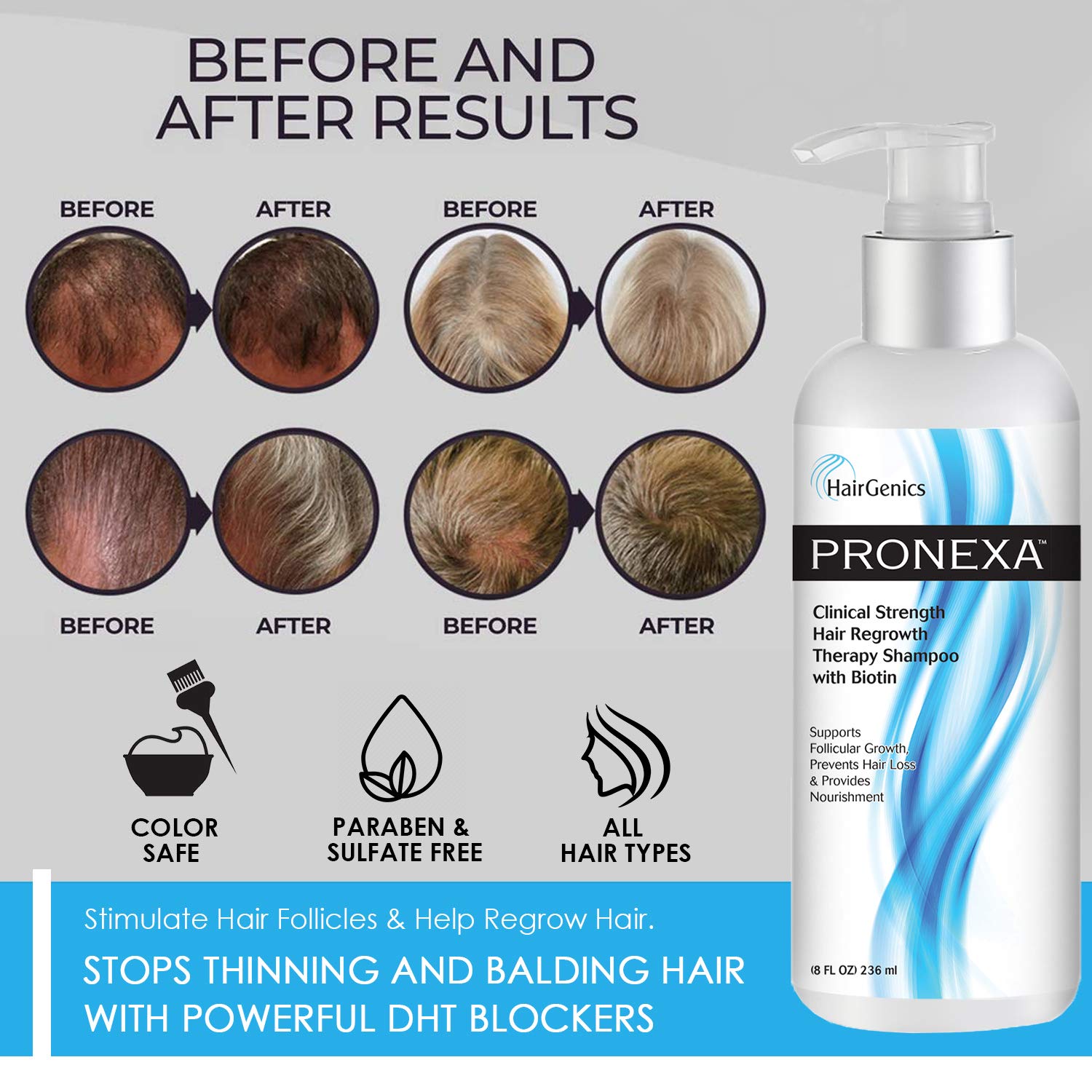 Hairgenics Pronexa Clinical Strength Hair Growth & Regrowth Therapy Hair Loss Shampoo With Biotin, Collagen, And Dht Blockers For Thinning Hair, 8 Fl. Oz. : Beauty & Personal Care