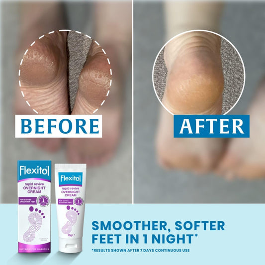 Flexitol Rapid Revive Overnight Foot Cream - 30 Percent Urea For Extremely Dry, Hard, Rough Skin On Feet - Results In 1 Night - Clinically Proven Foot Care - High Urea - Suitable For Diabetics. 50G