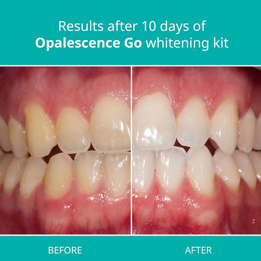 Opalescence Go - Prefilled Teeth Whitening Trays - Original 15% - (4 Treatments) - Hydrogen Peroxide - Cool Mint - Made by Ultradent. 4PK-GO-15