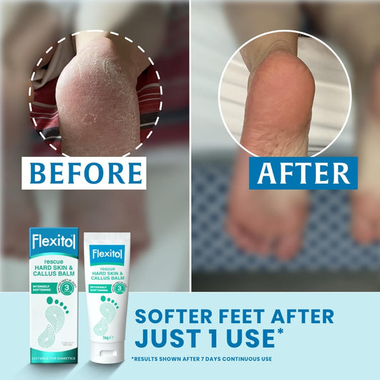 Flexitol Rescue Hard Skin And Callus Balm - Foot Cream For Visible Results In 3 Days - Exfoliates Dry, Hard Feet - Clinically Proven To Soften Feet - 22 Percent Urea - Suitable For Diabetics. 56G