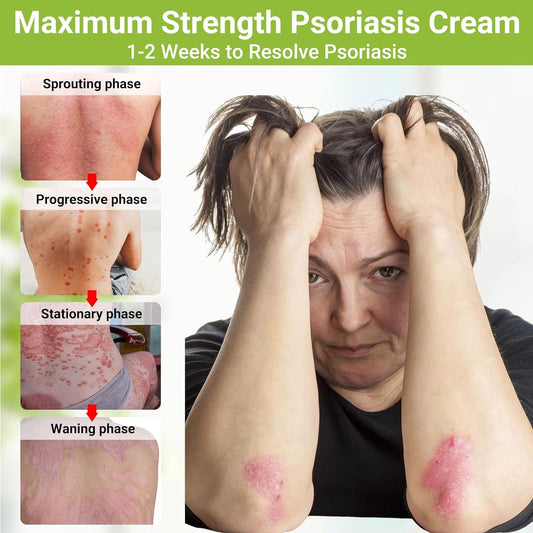 Psoriasis Cream, Maximum Strength Treatment Moisturizing Cream for Psoriasis, Dermatitis, Rash, Anti-Itch, Redness, Flaking, Scaling, Fast Acting Relief for Irritated, Dry Skin