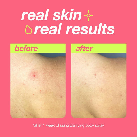 Dermalogica Clear Start Clarifying Body Spray - Treats & Prevents Body Breakouts, On-The-Go Skincare, Mist Application, Clears & Reduces Redness, Suits All Skin Types (177Ml)