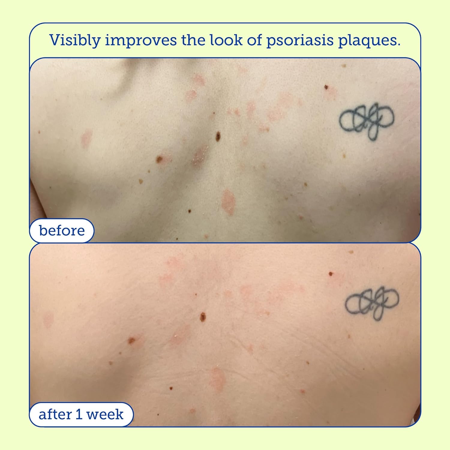 Skinfix Kp+ Psoriasis Smoothing Treatment Body Lotion 5.07 Oz / 150 Ml : Beauty & Personal Care