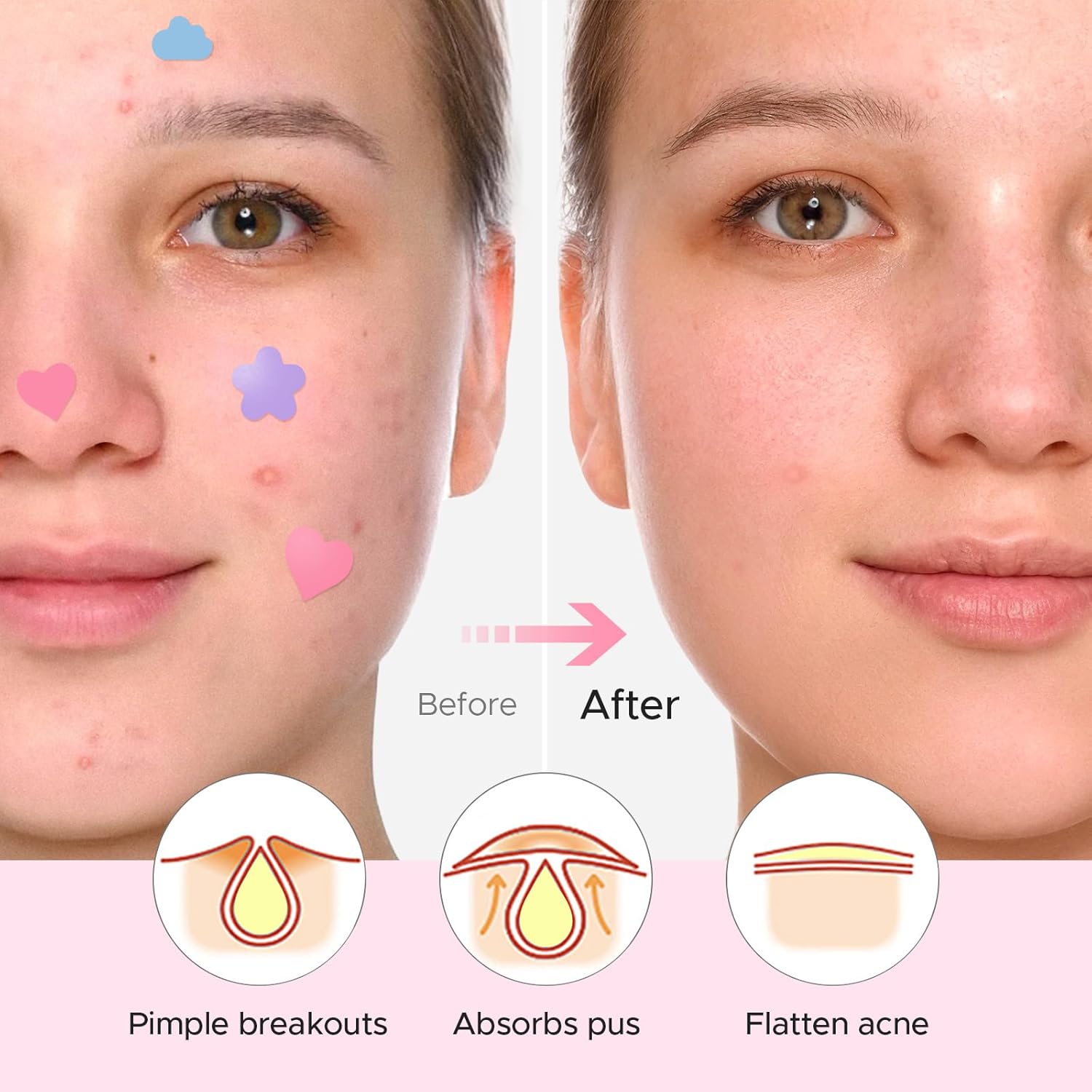 Litbear Acne Pimple Patch, 360 Dots 3 Shaped Colors Pimple Patches With Salicylic Acid, Tea Tree Oil & Calendula Oil, Hydrocolloid Acne Patch For Face, Blemish, Cute Zit Patch Pimple Sticker Acne Dots : Beauty & Personal Care