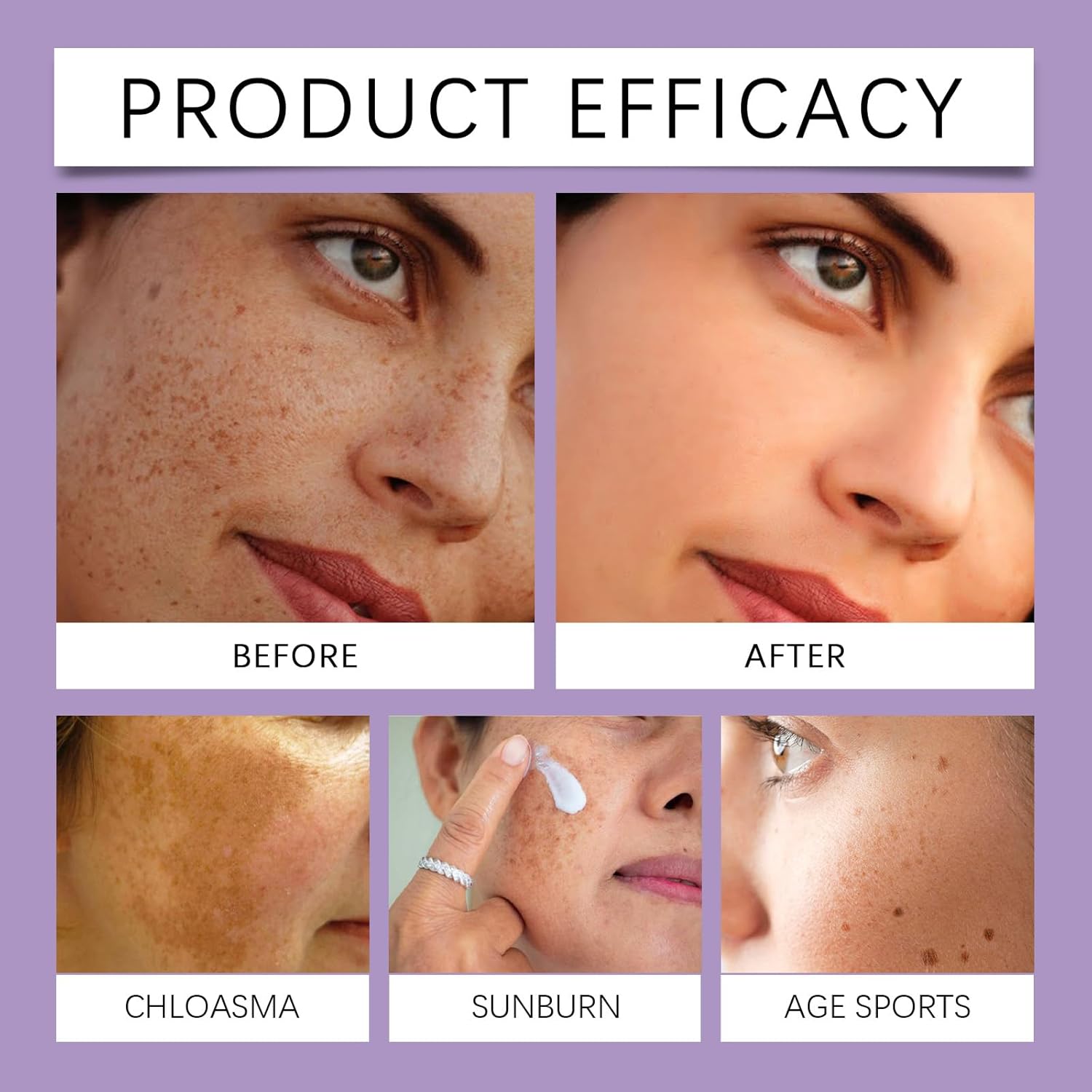 Pigmentation Removal Cream, Anti-Hyperpigmentation Cream, Skin Advanced Creams, Anti-Ageing Face Hyperpigmentation Treat For All Type Skin, 20G