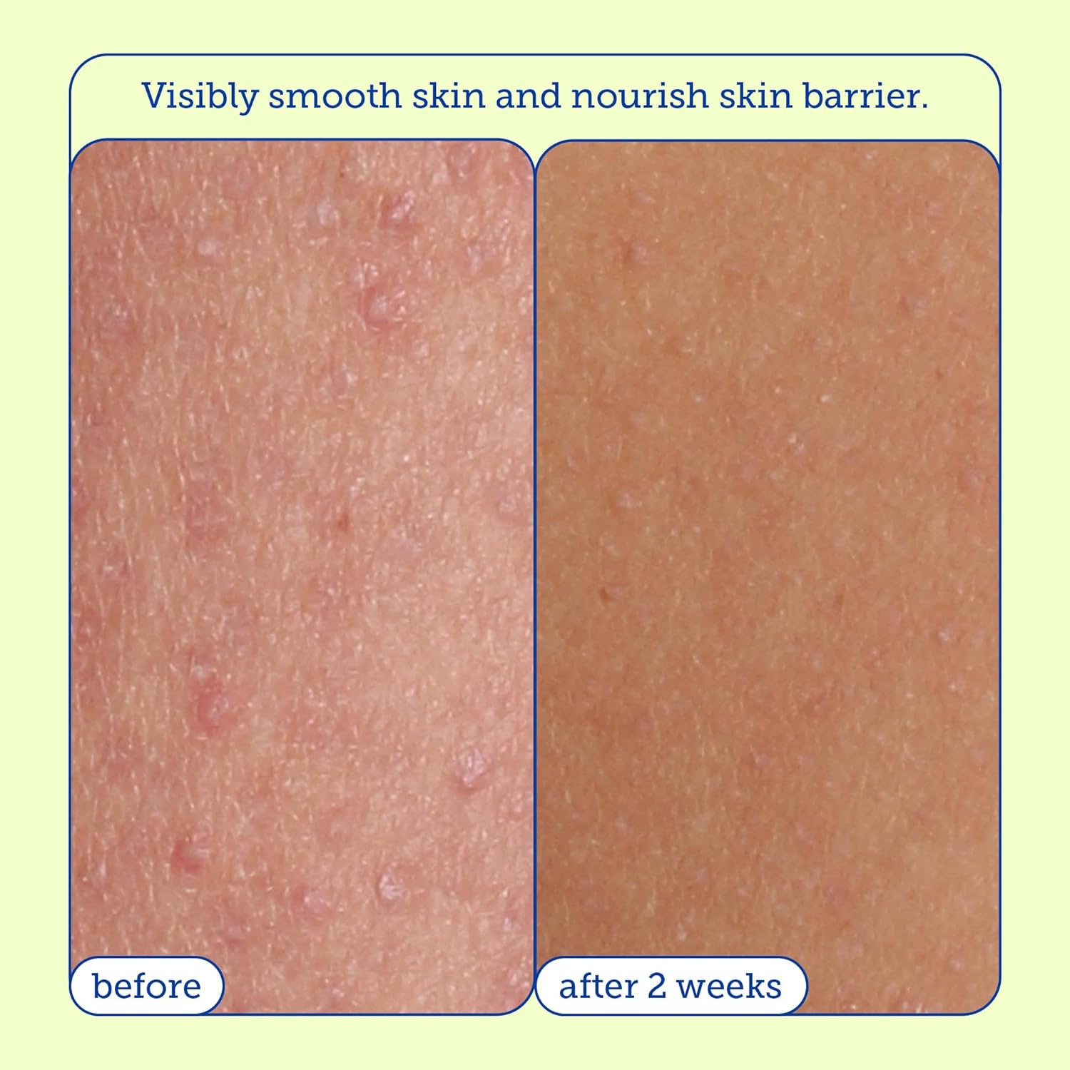 Skinfix Resurface+ Aha/Bha Renewing Cream: Exfoliating Body Cream That Visibly Smooths Rough, Bumpy & Crepey Skin While Moisturizing With Shea Butter, Jojoba Oil & Glycerin, 10 Fl Oz : Beauty & Personal Care