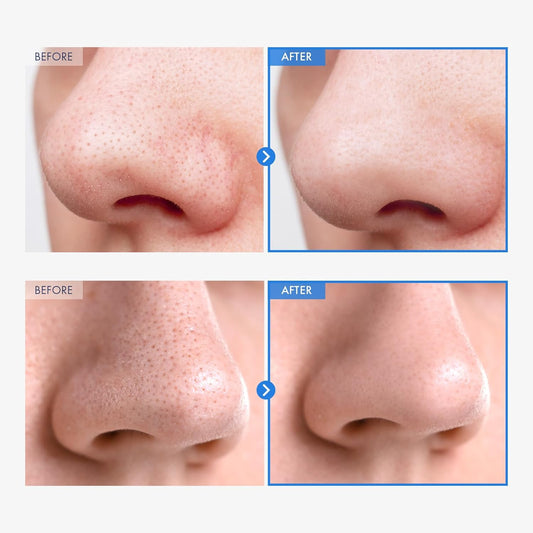 Aha Deep Cleansing Facial Oil With Jojoba Oil, Tea Tree Oil, Pha And Centella Asiatica, Korean Blackhead Remover, Pore Cleaner And Sebum Remover, 145Ml, 4.9 Fl. Oz