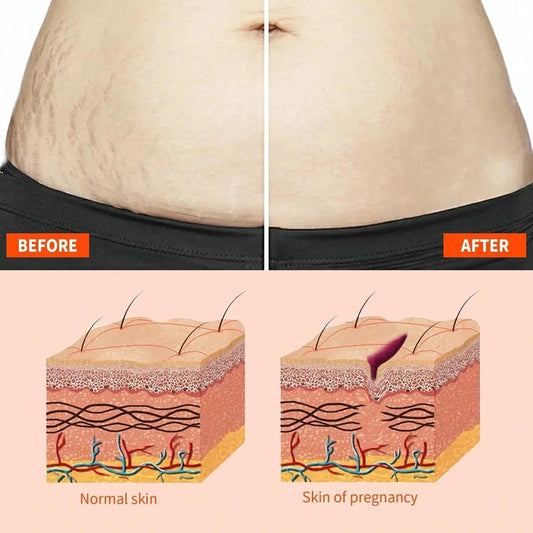 Stretch-Marks, Scar Treatment Oil - Boosts Collagen For Skin Lifting - Improves Treat Of Scars, Stretch-Marks & Uneven Skin Tone - 125Ml