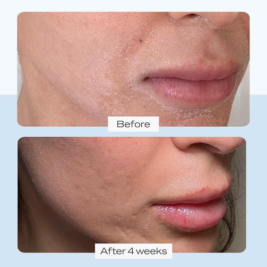 First Aid Beauty Ultra Repair Cream Intense Hydration Moisturizer For Face And Body - 8 Oz