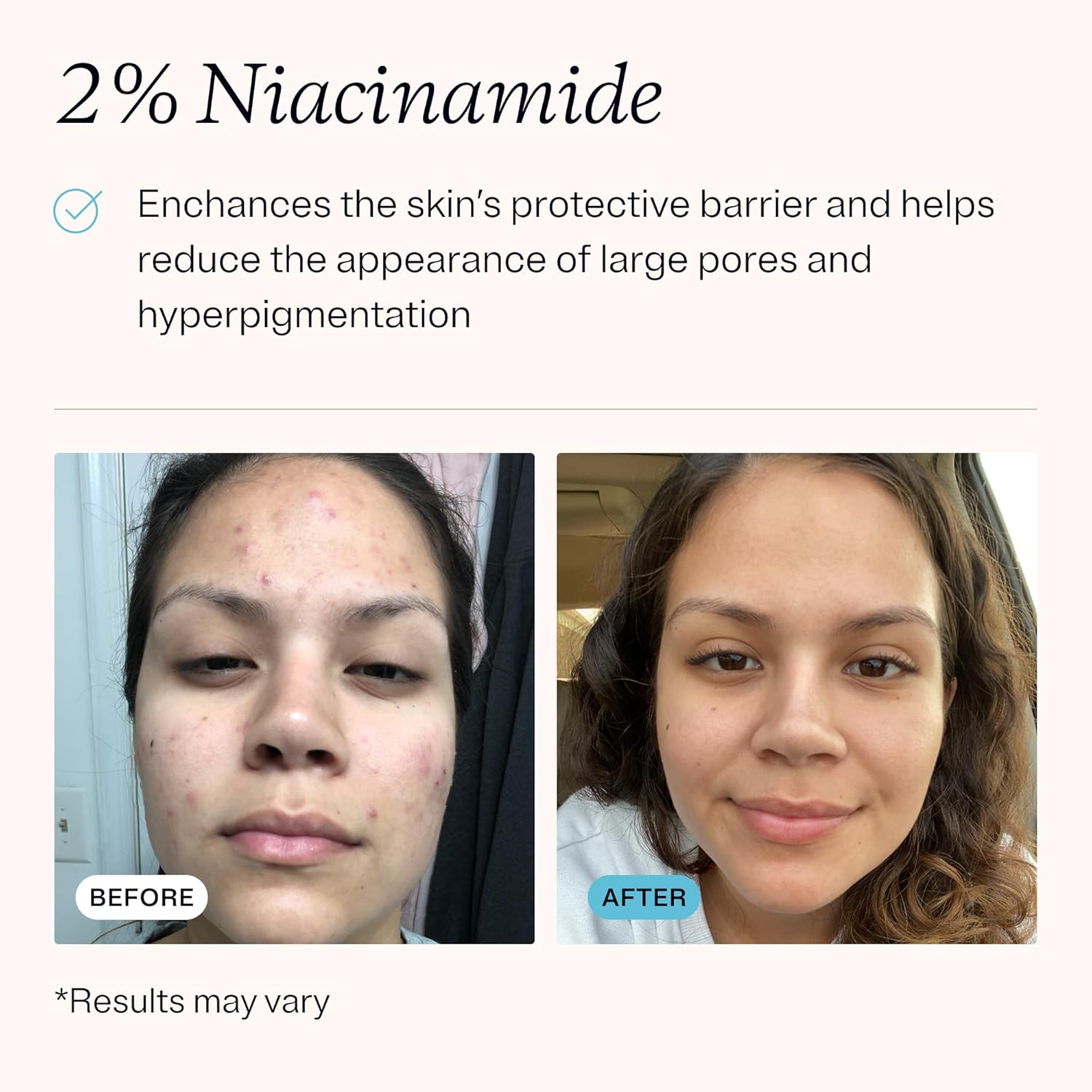 Mdacne – Retinol 0.25% And Niacinamide 2% Cream, Reduces Blemishes And Improves Skin Texture Without Irritation : Beauty & Personal Care