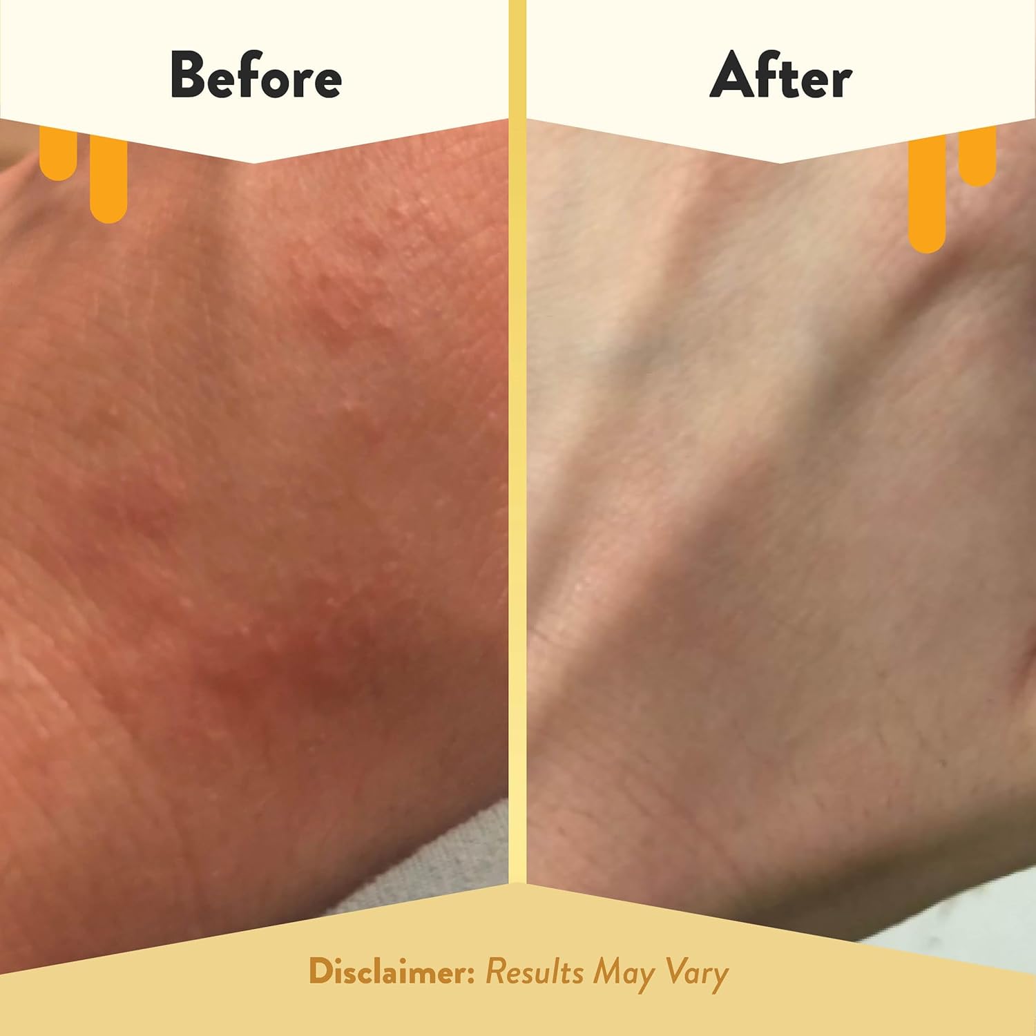 Eczema Honey Oatmeal Body Lotion - Hand & Body Cream For Eczema Relief - Natural Dry Skin Repair (16 Oz) : Beauty & Personal Care