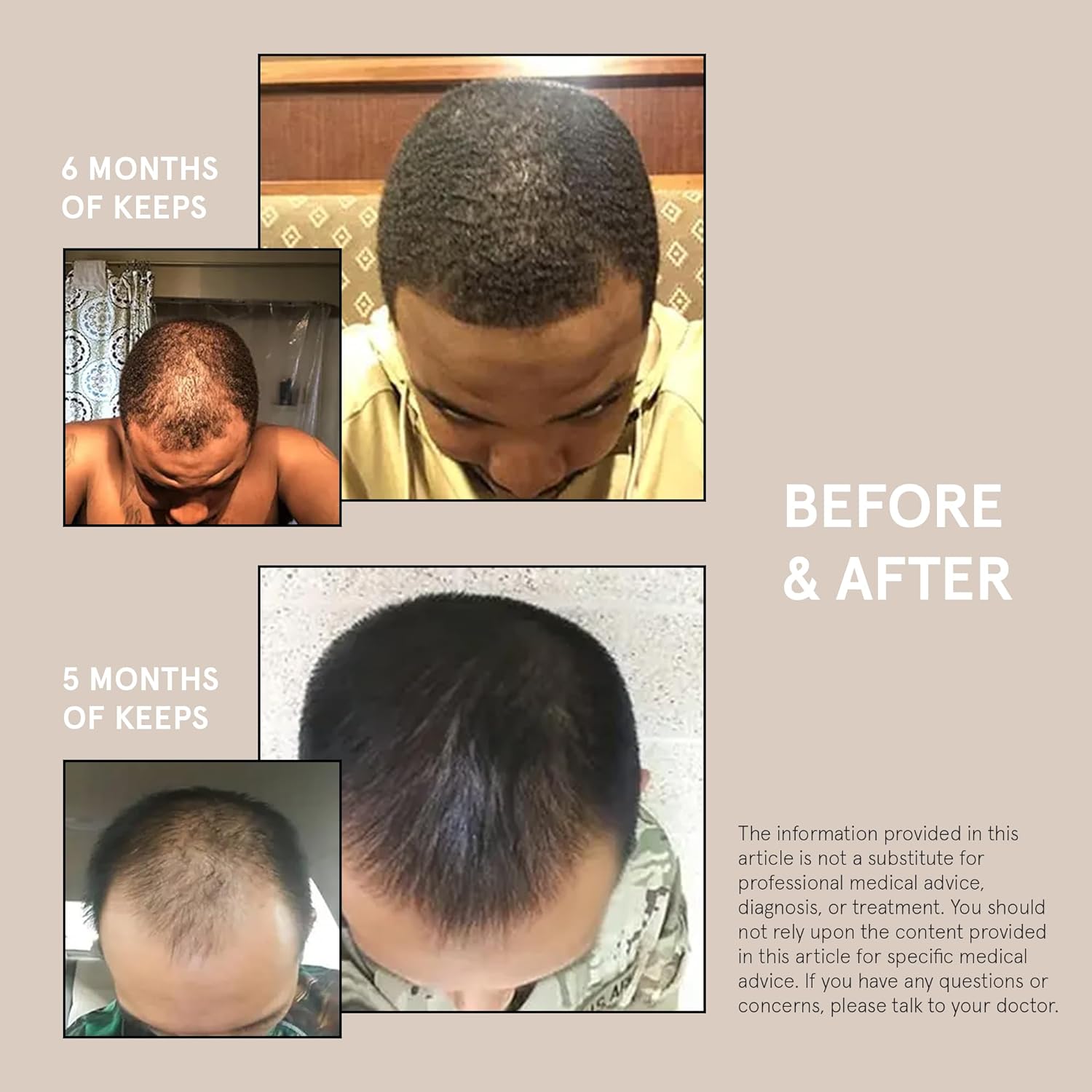Keeps Extra Strength Minoxidil for Men Topical Aerosol Foam 5%, Hair Growth Treatment - 3 Month Supply (3 x 2.11oz Bottles) - Thicker, Longer Hair - Slows Hair Loss & Promotes Hair Regrowth : Beauty & Personal Care