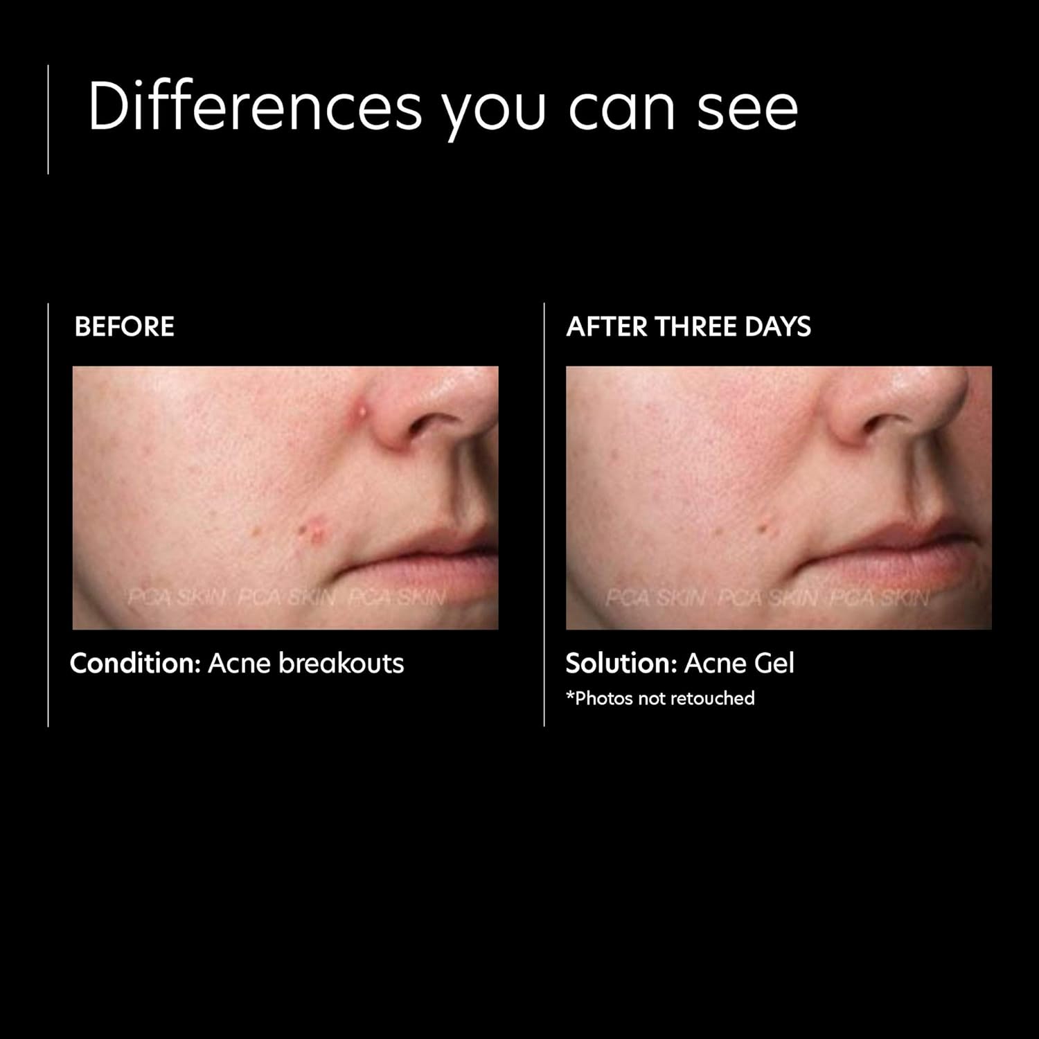 PCA SKIN Acne Spot Treatment Facial Gel - 2% Salicylic Acid Brightening Face Serum for Excess Oil, Breakouts & Dark Spots (1 fl oz) : Beauty & Personal Care