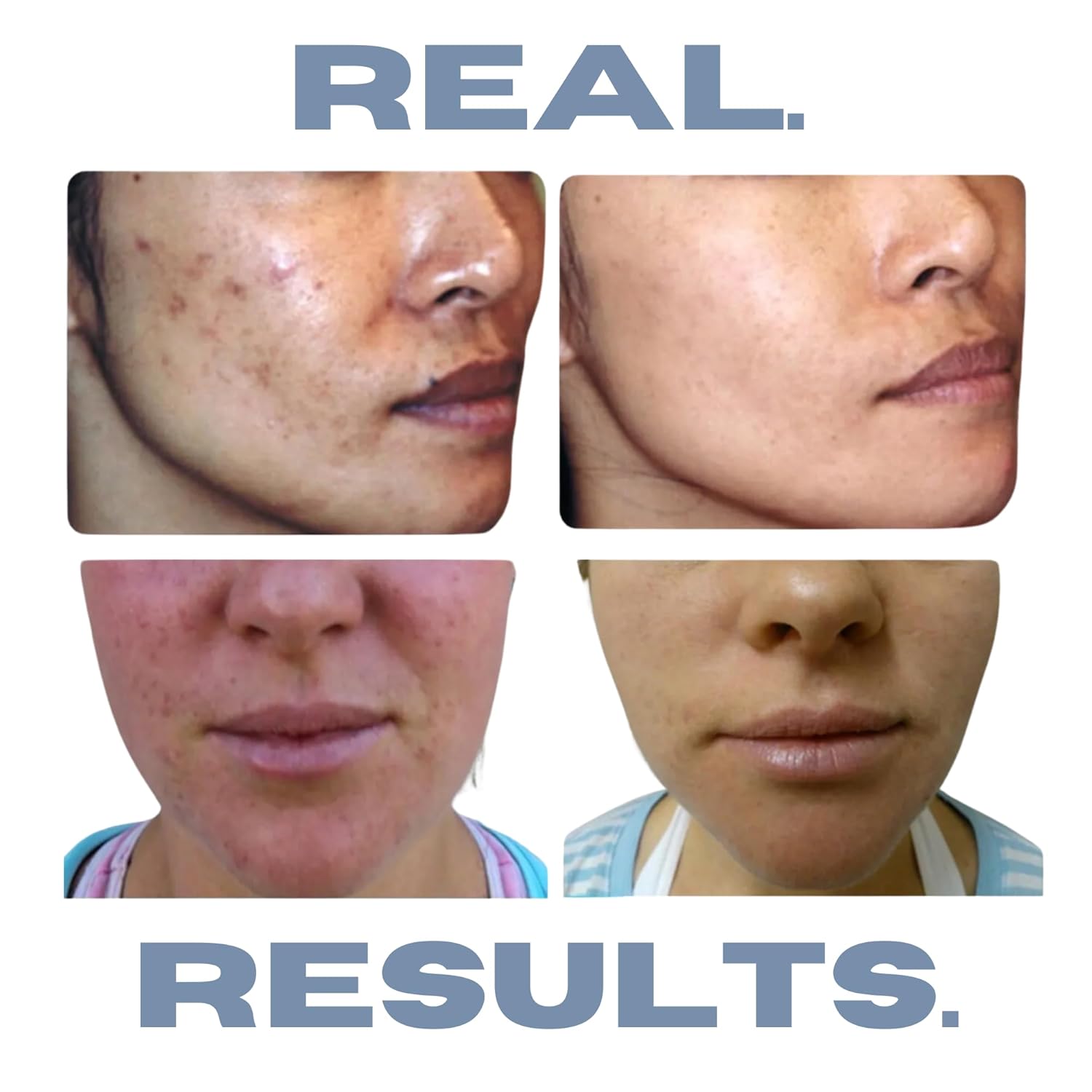 Clearogen Hormonal Acne Solution Natural Anti-Dht Ingredients Formula Benzoyl Peroxide, 1 Month Original Benzoyl Kit : Beauty & Personal Care