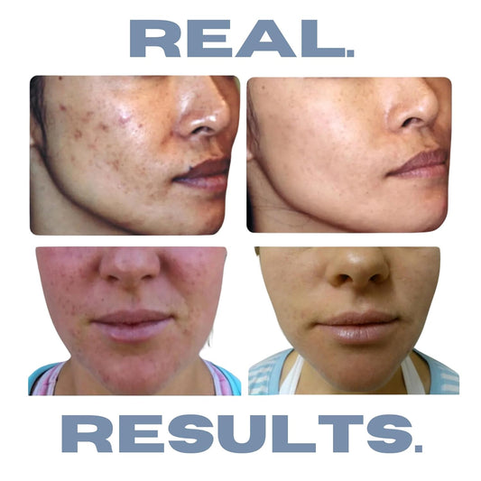 Hormonal Acne Solution Natural Anti-Dht Ingredients Deluxe Set Original Formula Benzoyl Peroxide 2 Month Supply 3 Piece Set