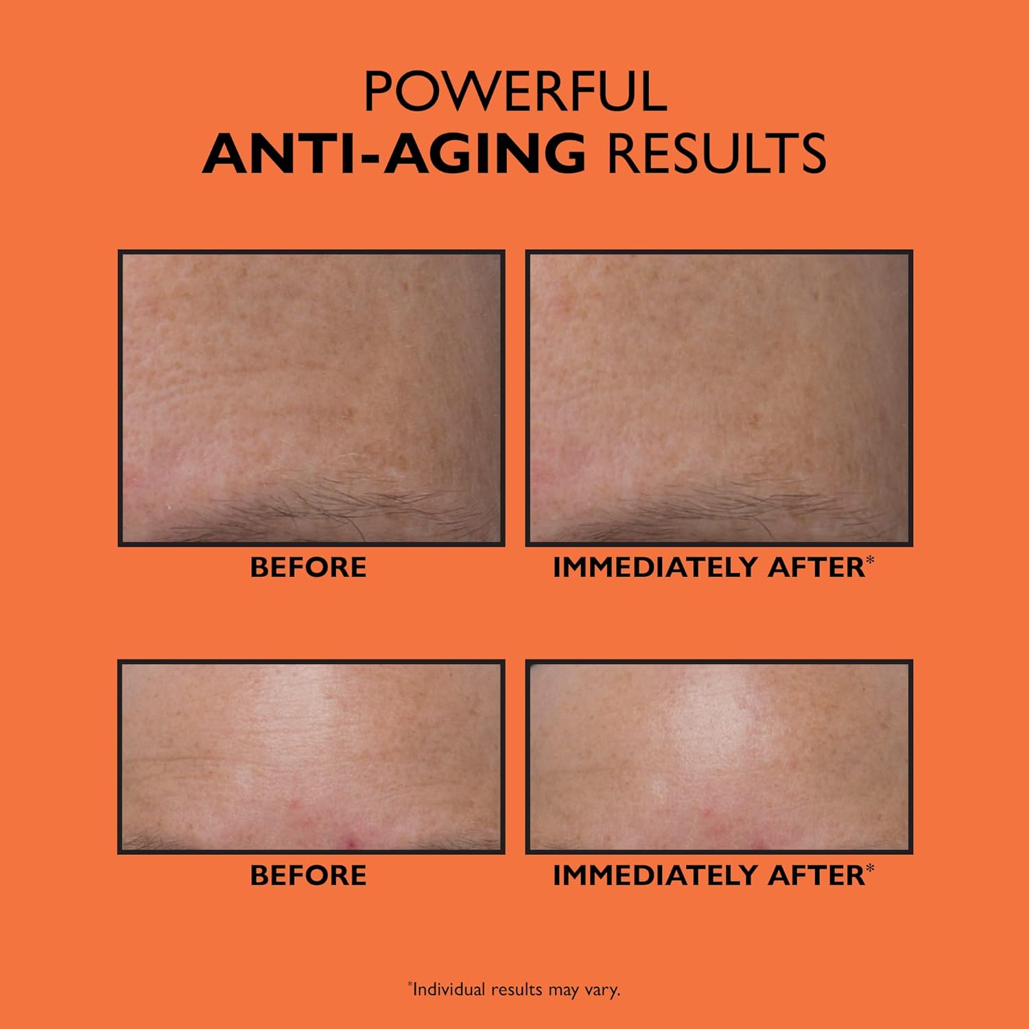 Peter Thomas Roth Anti-Aging Triple Acid Peel | Exfoliator and AHA/BHA Peel for Fine Lines, Wrinkles, Uneven Texture and Tone : Beauty & Personal Care
