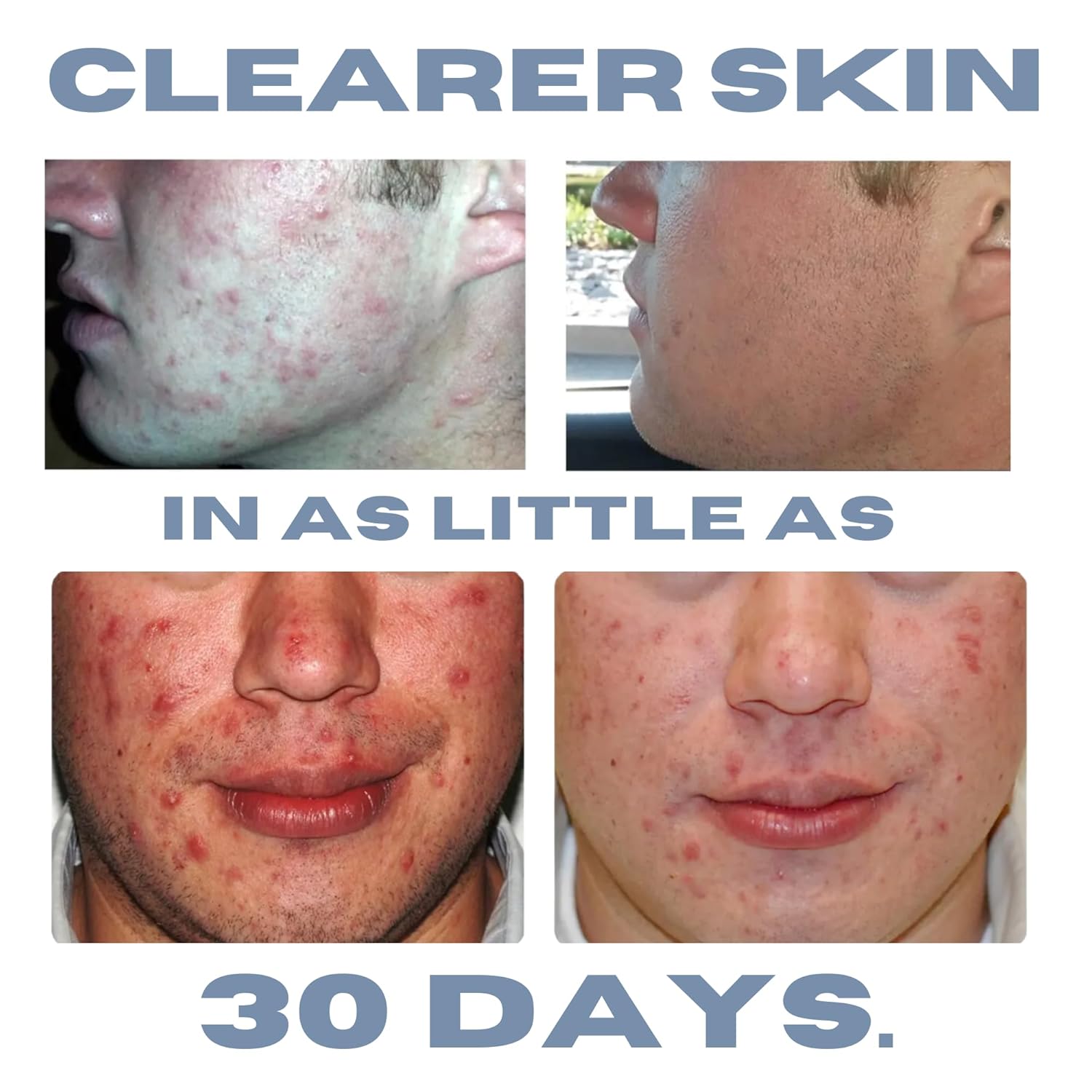 Clearogen Sensitive Skin Sulfur Acne Lotion, Acne Treatment, Sulfur Cream, Sulfur Ointment, Sulfur Spot Treatment, Sulfur Acne Treatment Cream 1.8 Fl Oz : Beauty & Personal Care