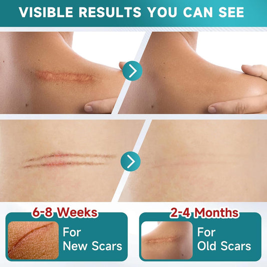 Silicone Scar Sheets, Silicone Scar Tape(1.8” X 157” Roll-4M), Scar Removal Away Strips For Surgical Scars, Keloid, C-Section, Burn Et