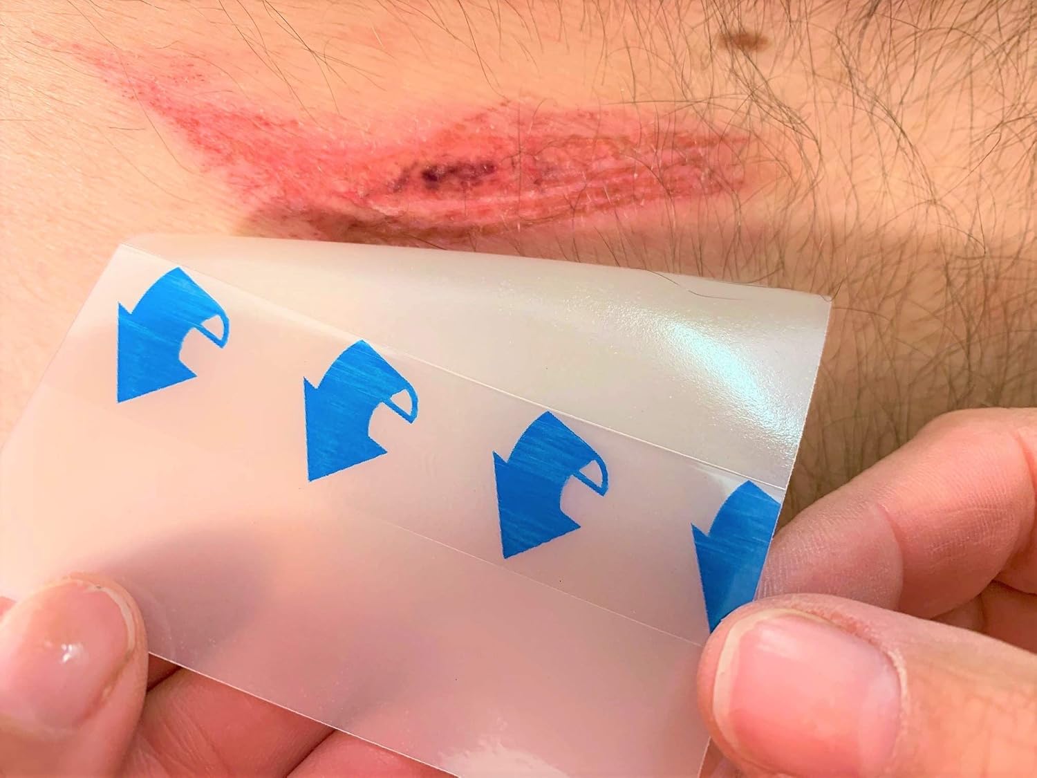 Hydrocolloid Thin Wound Dressing – Waterproof, Breathable & Adhesive Patches For Faster Healing, Blister & Acne Protection – Ideal For Sensitive Skin - 10X10Cm X 5