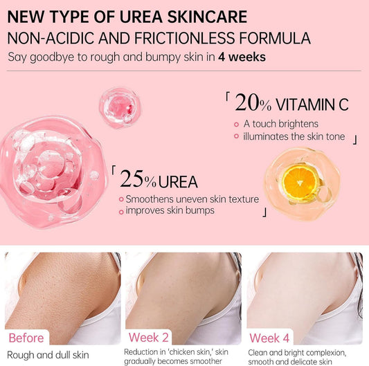 Keratosis Pilaris Lotion, Legs Treatment Body Cream Skin Exfoliating Repair Cream Chicken Skin Care Cream,Exfoliating Body Cream Rough Bumpy Skin Body Lotion Moisturizing Cream Gets Rid Of Redness