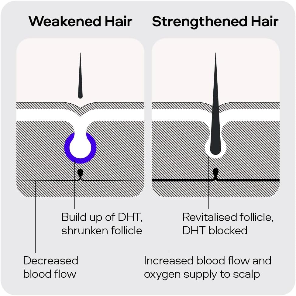 Sons Minoxidil 5%, Strengthening Shampoo and Dermaroller. Hair Regrowth Treatment. Hair Growth Shampoo With Caffeine. Thickening, Anti-Dandruff, DHT Blocker. 1 Month Supply. Made in Europe. : Amazon.co.uk: Beauty