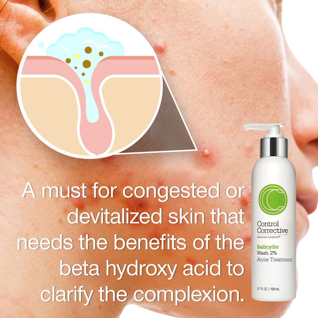 Control Corrective Salicylic Wash 2%, 6.7 Fl Oz - Excellent For Oily Or Acne-Prone Skin, Creamy/Gel Cleanser Helps Reduce And Control Breakouts Without Overstripping : Beauty & Personal Care