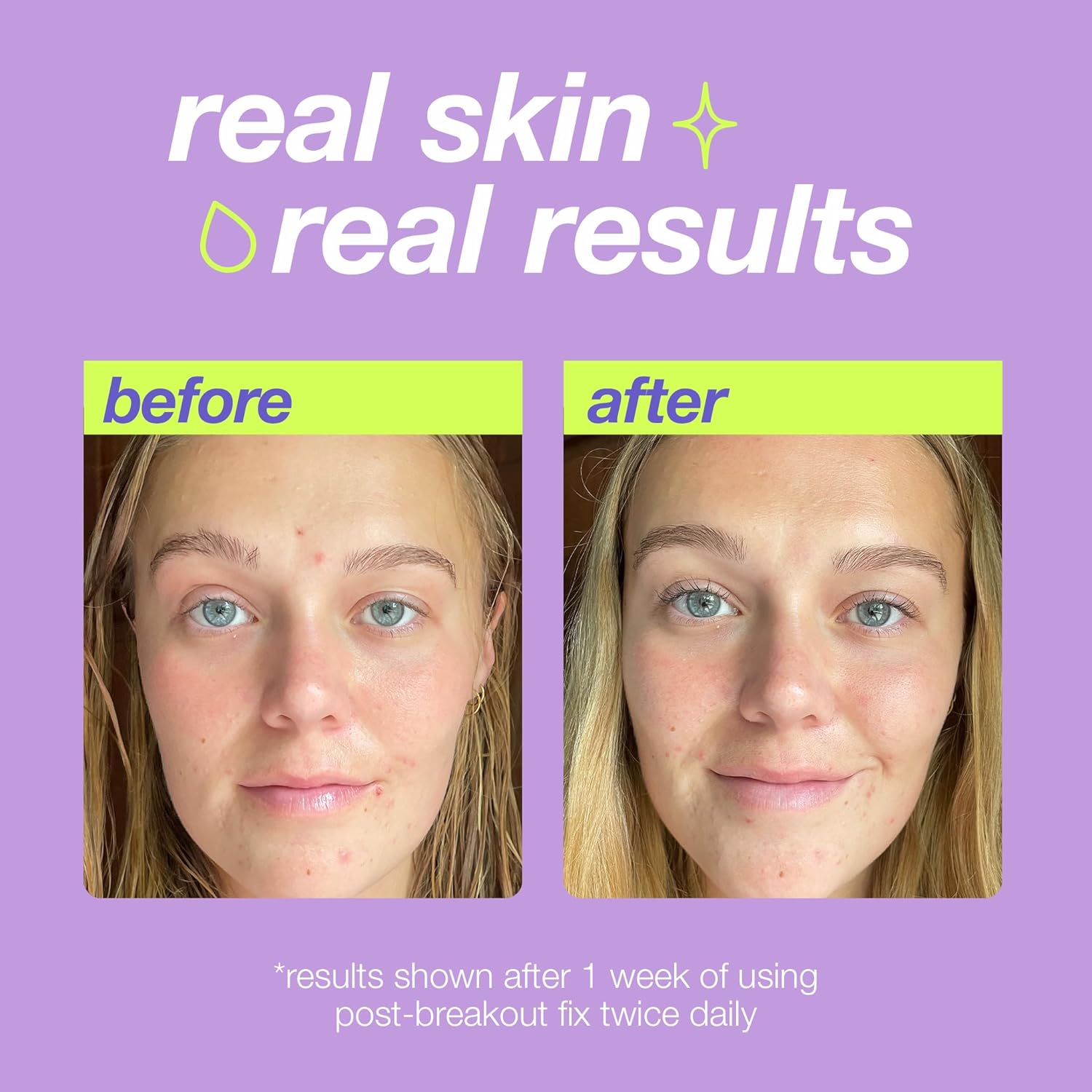 Dermalogica Clear Start Post-Breakout Fix, Acne Dark Spot Treatment With Salicylic Acid, Squalene & Hexylresorcinol, Fade + Brighten Acne Marks : Beauty & Personal Care