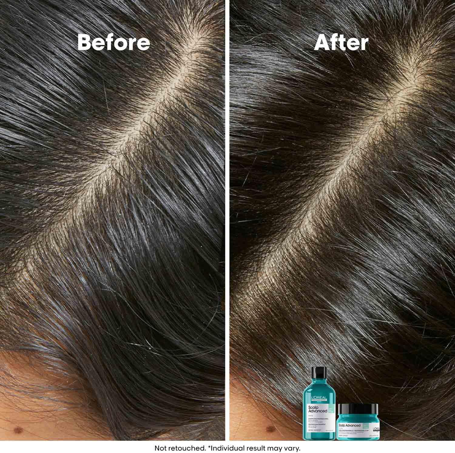 L'Oréal Professionnel Serie Expert Scalp Advanced Anti-Oiliness Hair Shampoo & Mask Duo : Amazon.co.uk: Beauty