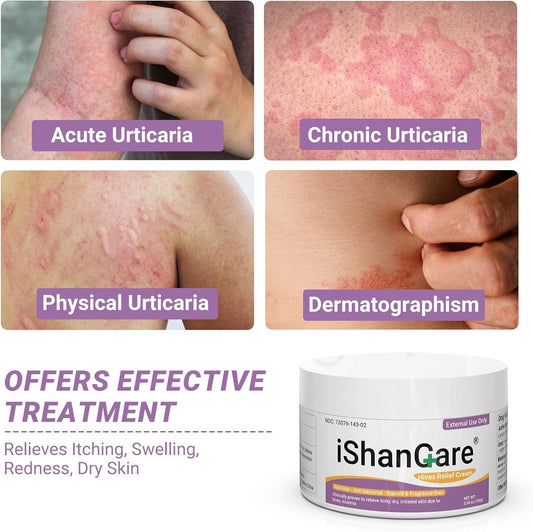 Urticaria Cream, Fast Acting Relief Of Hives, Allergic Rashes, Itchy Skin, Redness, Swelling, Anti Fungal Hives Cream With All Natural Herbal Ingredients, 3.53 Oz