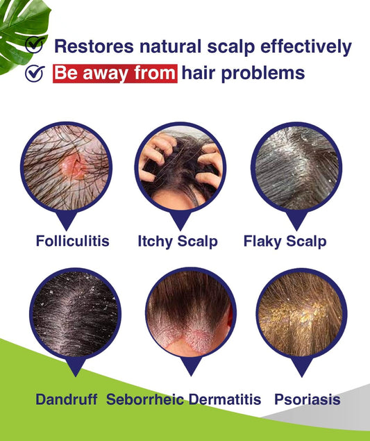 Anti-Fungal Shampoo For Folliculitis, Seborrheic Dermatitis, Scalp Psoriasis - Relieves Itchy & Dry Scalp