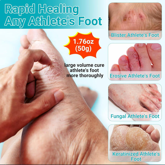 Athletes Foot Treatment Cream, Maximum Strength For Athlete'S Foot (Tinea Pedis), Itching, Blister, Burning, Cracking, Scaling, Beriberi,Natural Herbs Antifungal Foot Cream