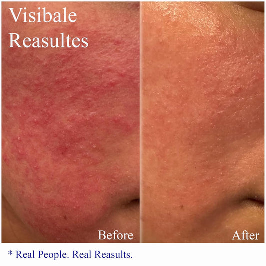 Hey Honey Skincare Relax, Instant Rosacea Treatment & Face Redness Relief - Dermatologically Tested Calming Moisturizer For Sensitive Skin Oil- Free With Honey & Propolis Anti-Aging Benefits | 2.2 Oz