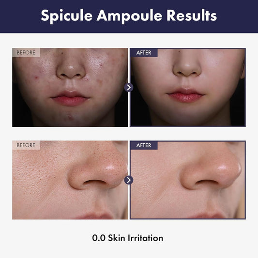 Real Spicule Ampoule With 30,000 Shots, Niacinamide, Panthenol, Liquid Skin Booster Serum, Pore Minimizer, Exfoliating, Dead Skin Cells, Skin Texture, Korean Skincare, 30Ml, 1.01 Fl. Oz