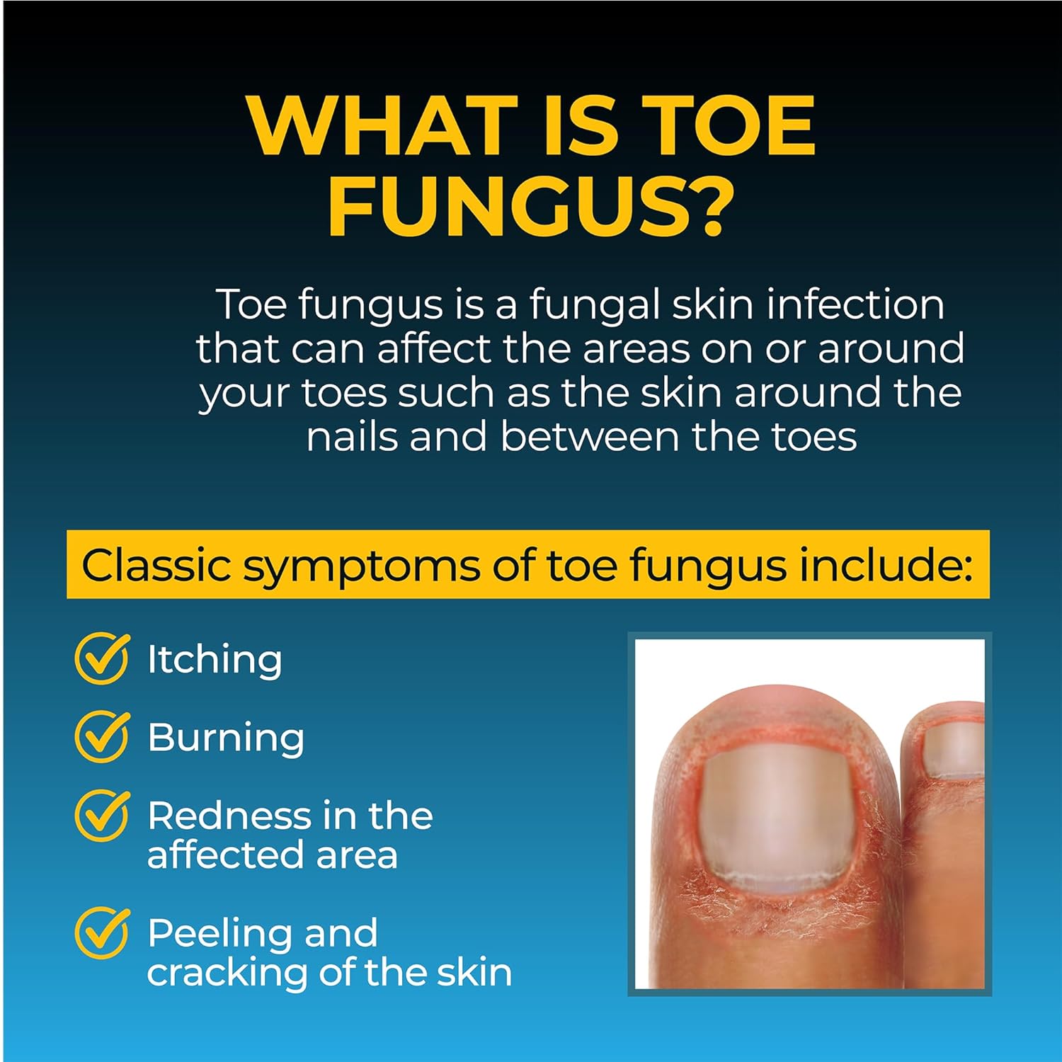 Fungi-Nail Anti-Fungal Ointment, 0.7 Ounce - Kills Fungus That Can Lead To Nail Fungus & Athlete'S Foot W/ Tolnaftate & Clinically Proven To Cure Fungal Infections : Nail Fungicides : Health & Household